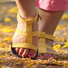 varicose veins