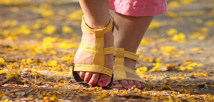 varicose veins
